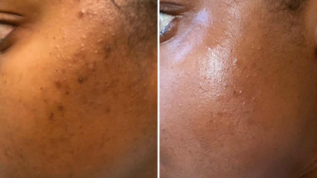 Dark Spot Skincare Routine For Black Men