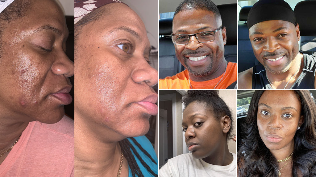 Dark spots store on skin