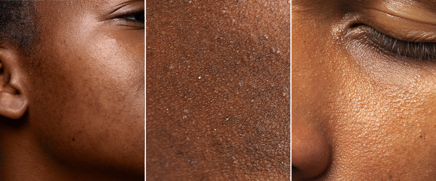 You May Have Dry Skin - Here's How To Tell On Darker Skin Tones