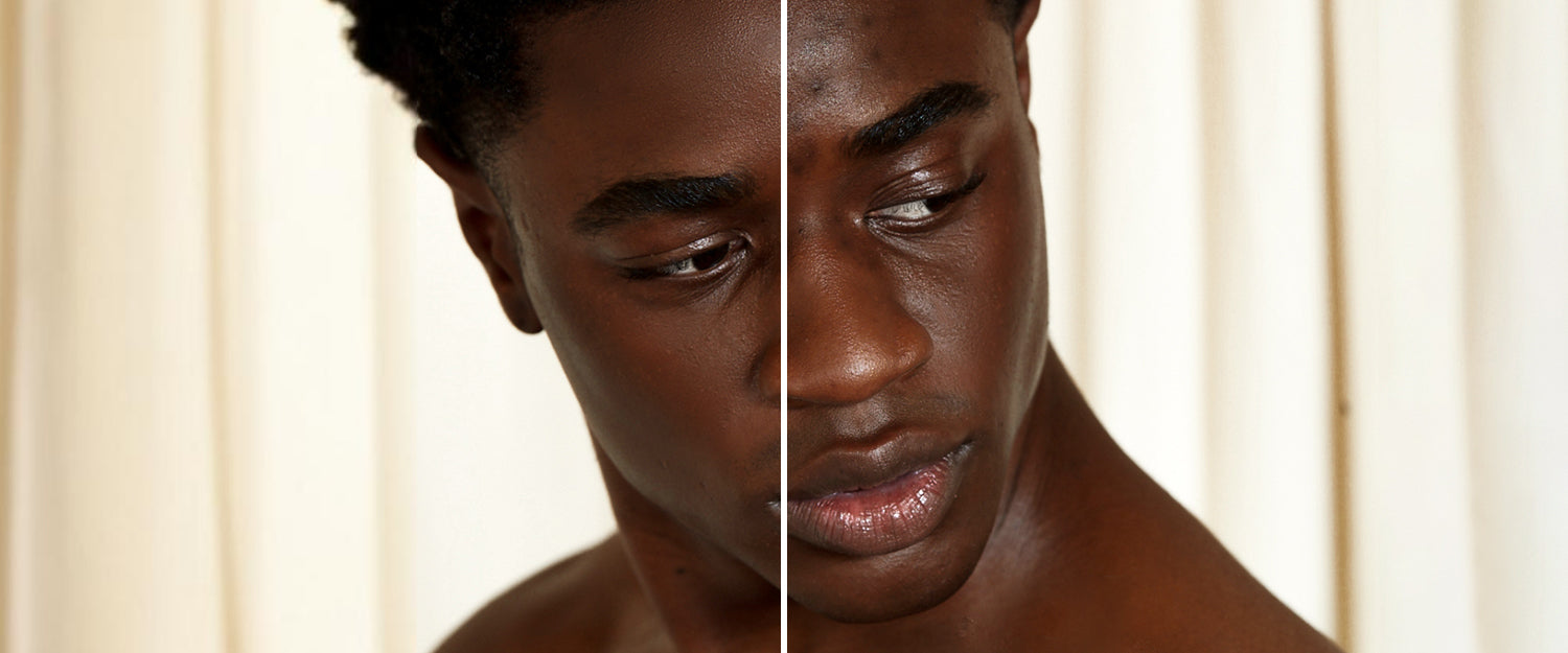 Before and after results showing dark spot fading progress using Buttah Vitamin C Serum on melanin-rich skin